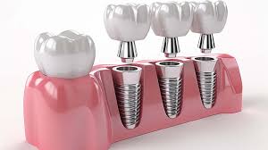Affordable Dental implants In Nagpur