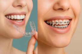 Braces Treatment In Nagpur