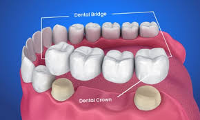 Dental Crowns and Bridges In Nagpur