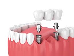 Dental Implants In Nagpur