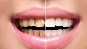 Full Mouth Rehabilitation In Nagpur