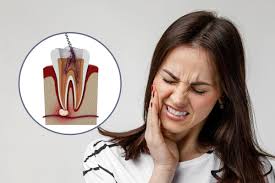 Painless Root Canal In Nagpur