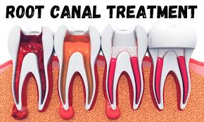 Root Canal Treatment In Nagpur