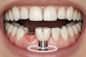 Teeth Implants In Nagpur