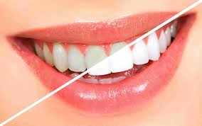 Teeth Whitening In Nagpur
