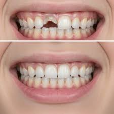 Tooth Implant cost In Nagpur