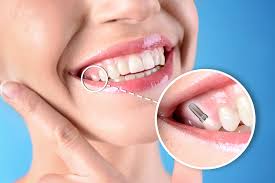 Tooth Replacement In Nagpur