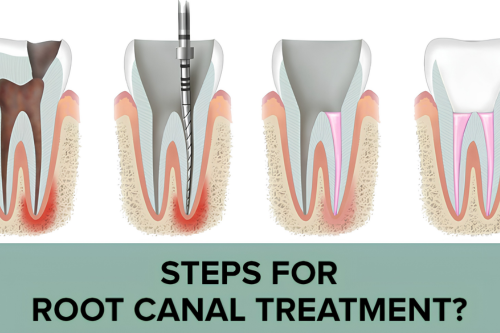 Root Canal