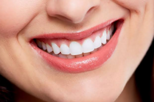 Smile Makeover